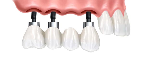 DentalImplant